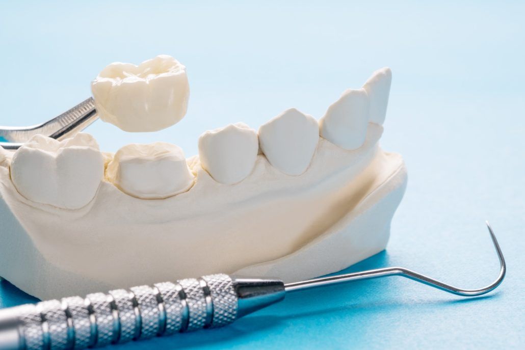  What to Expect With Dental Implants