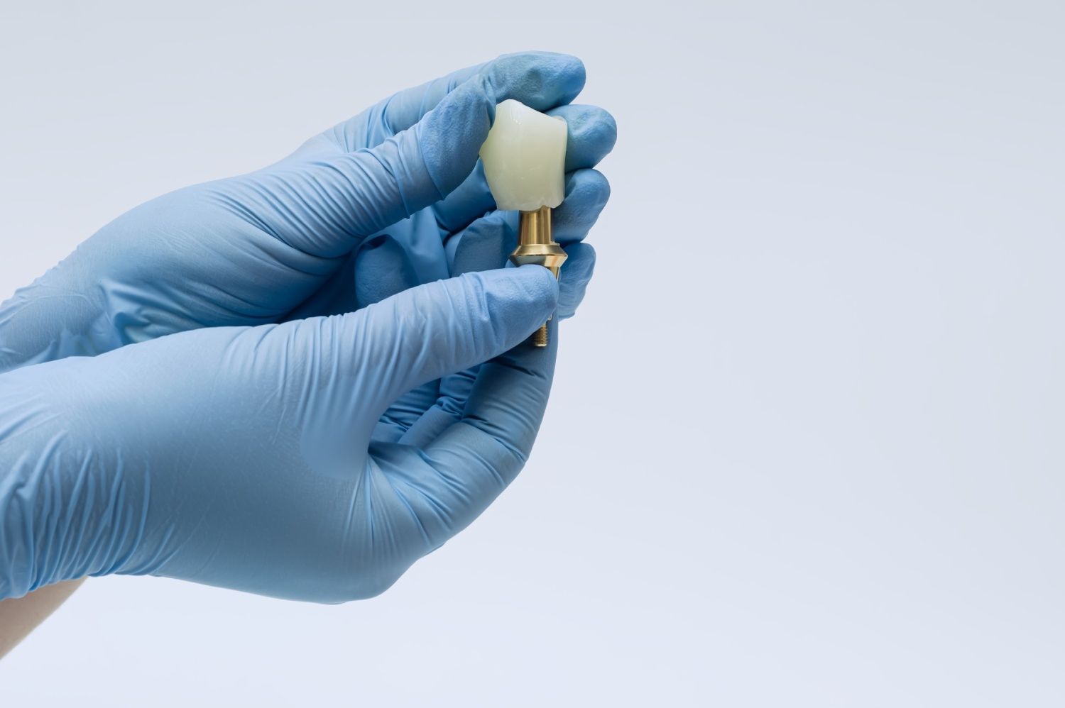 What Are Screwless Dental Implants: Benefits to Your Smile