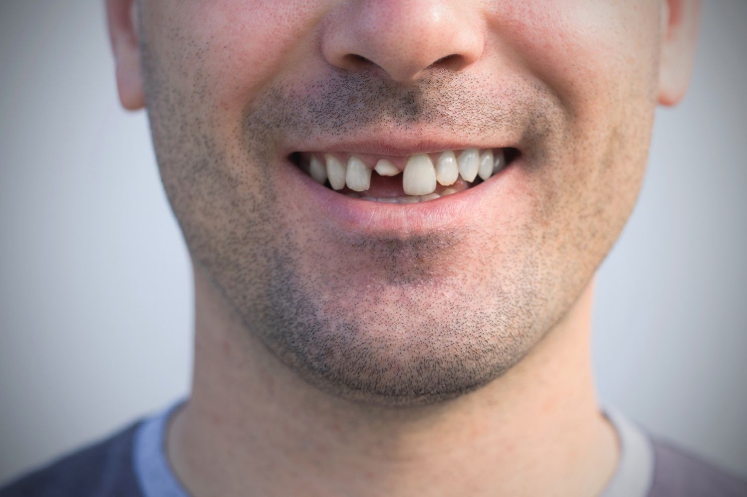 Broken Tooth Over The Holidays? What To Do And Where To Go In OKC