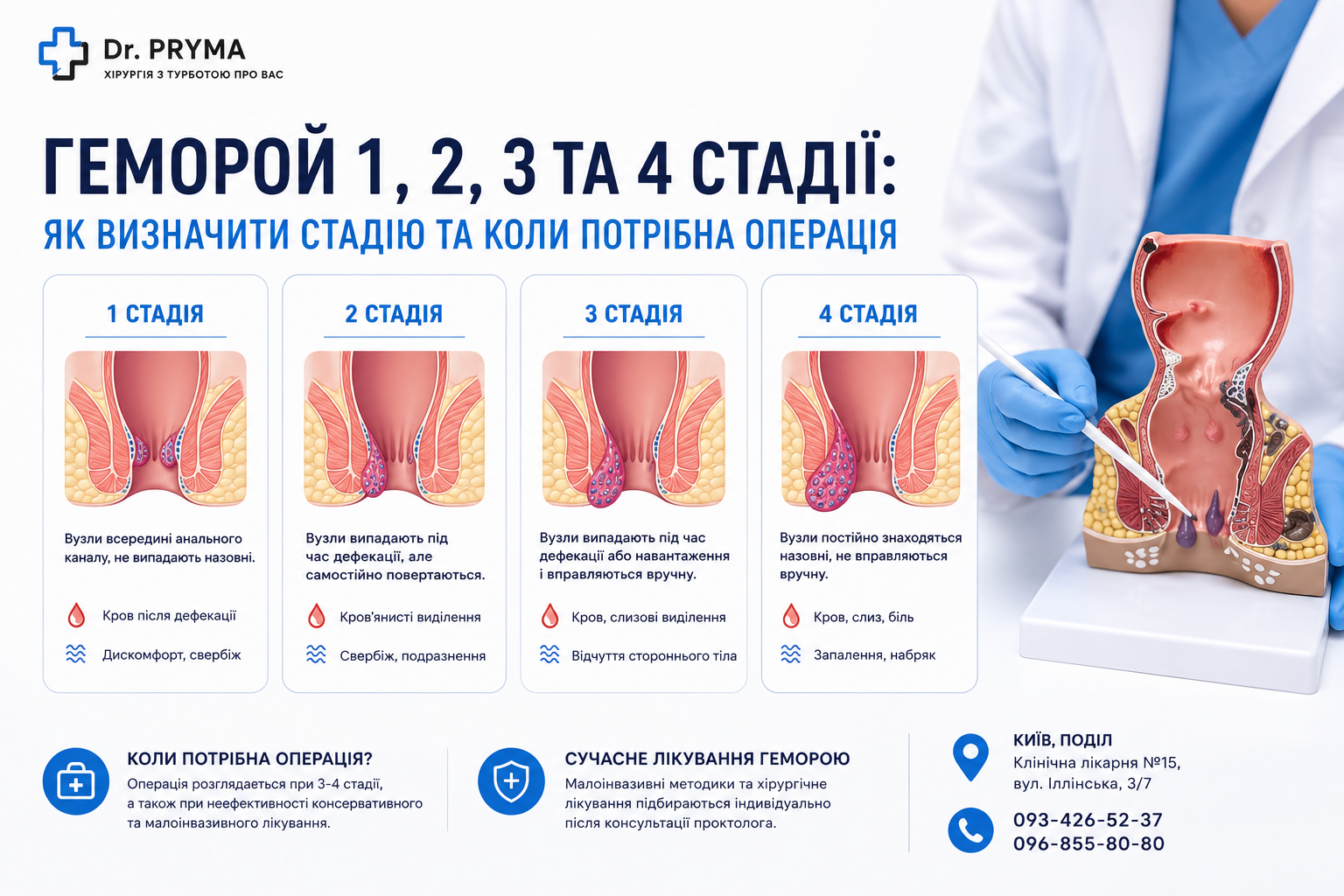 Геморой 1, 2, 3 та 4 стадії: як визначити стадію та коли потрібна операція | Київ