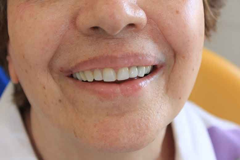 How Vitamin K2 is Beneficial for Dental Health?